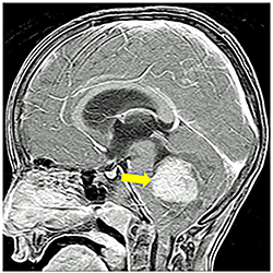 An image showing a Sonic Hedgehog medulloblastoma tumor.